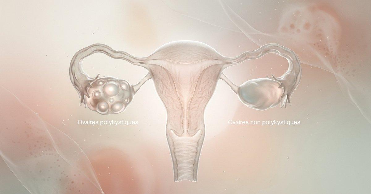 Du SOPK au SMOP : nouveau nom officiel du syndrome des ovaires polykystiques annoncé le 12 mai 2026