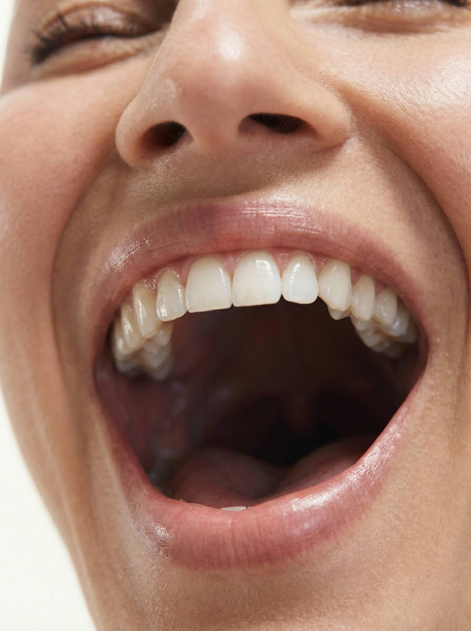 Zoom sourire grâce au Protocole Greffe osseuse